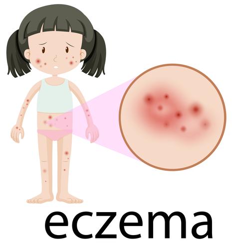 Uma menina com Eczema no fundo branco vetor