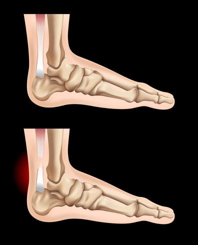 Pés humanos e lesão no tendão vetor