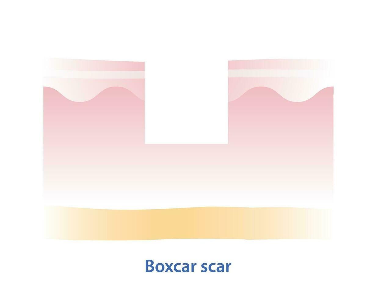 Cruz seção do vagão de carga cicatriz vetor ilustração isolado em branco fundo. vagão de carga cicatriz, atrófico cicatriz, tipo do acne cicatriz em pele superfície. pele Cuidado e beleza conceito.