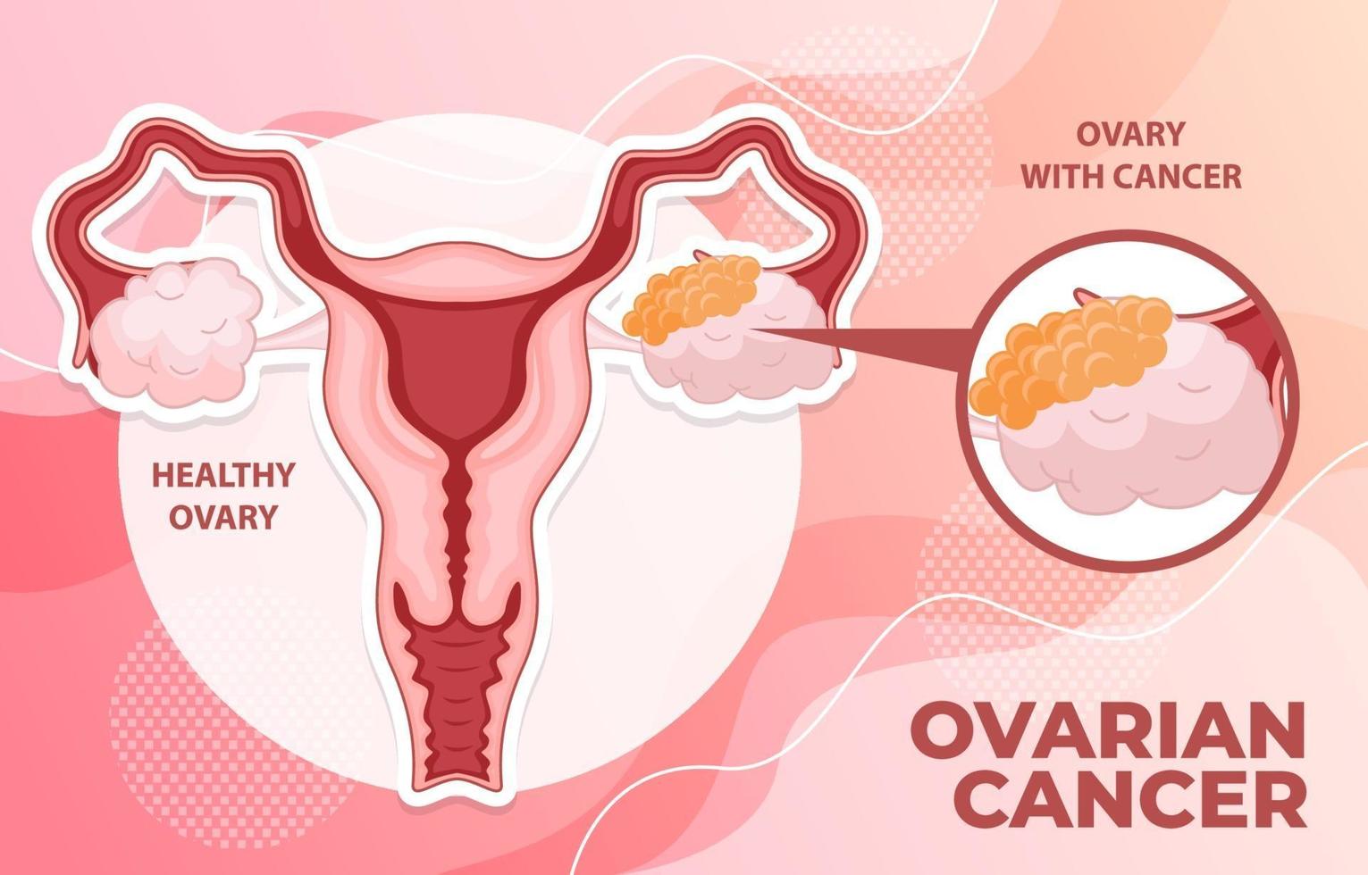 infográfico de câncer de ovário vetor