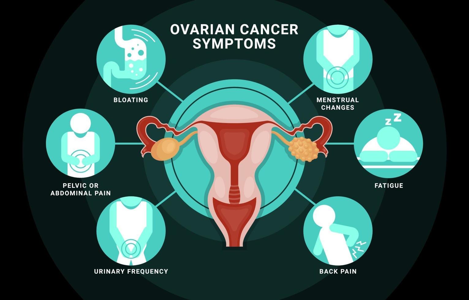 infográfico de sintomas de câncer de ovário vetor