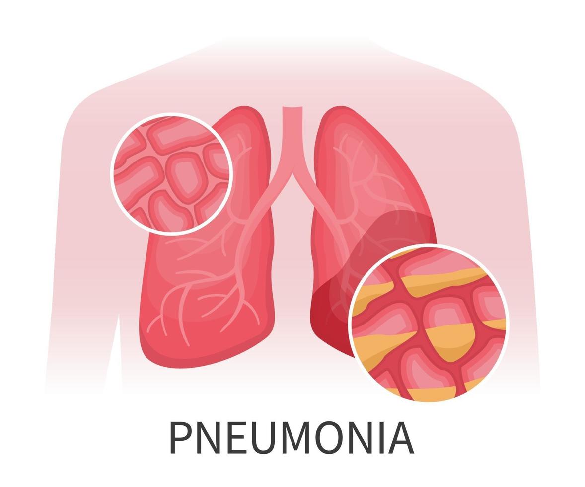 pulmões humanos danificados por pneumonia vetor