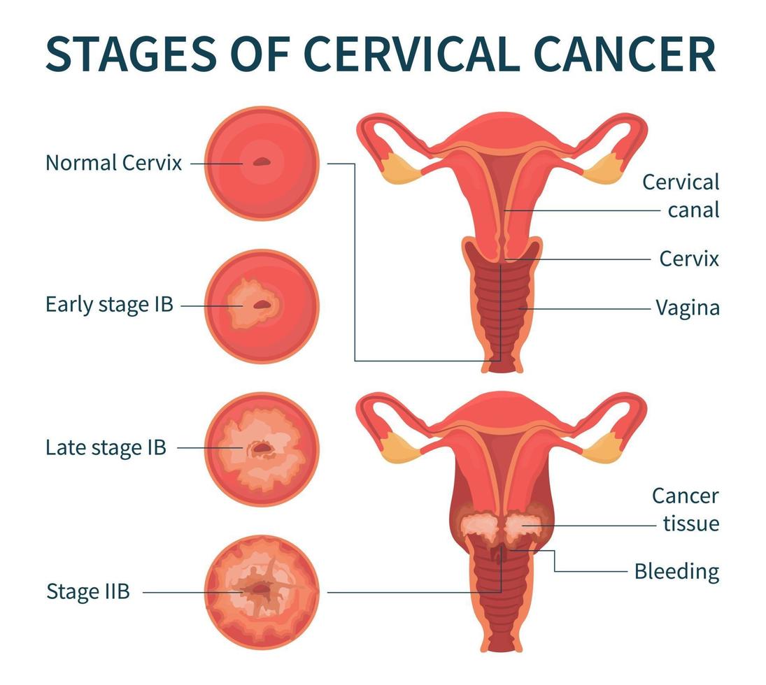 etapas do esquema de infográfico branco de câncer cervical vetor