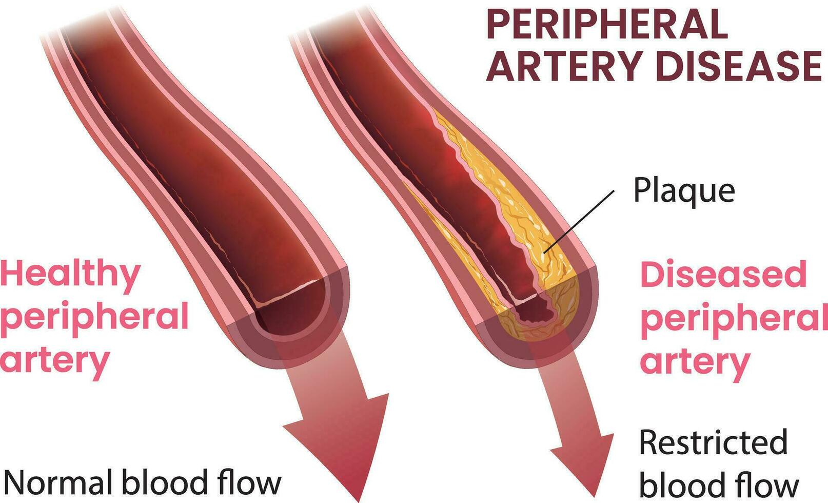 ilustração do periférico artéria doença infográfico vetor