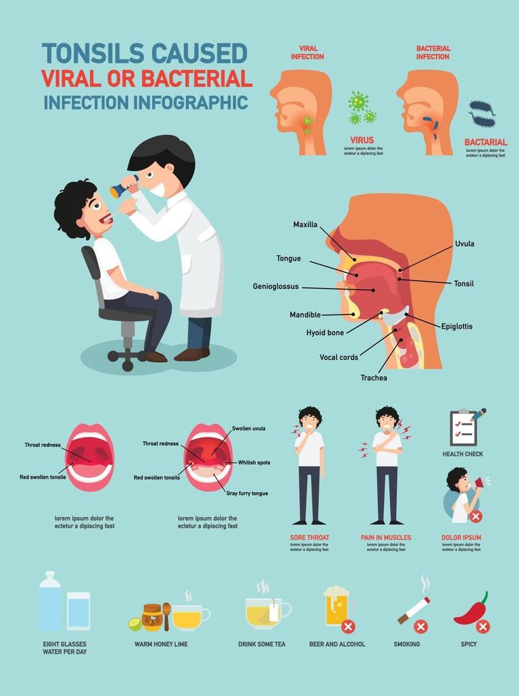 amígdalas causaram infecção viral ou bacteriana vetor