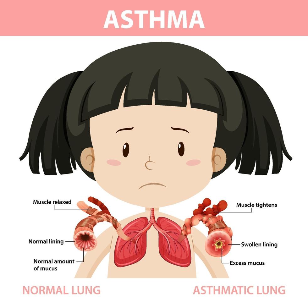 diagrama de asma com pulmão normal e pulmão asmático vetor