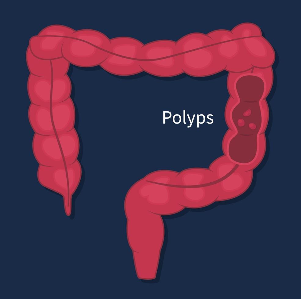 exame de pólipos de câncer de cólon endoscópico em vetor