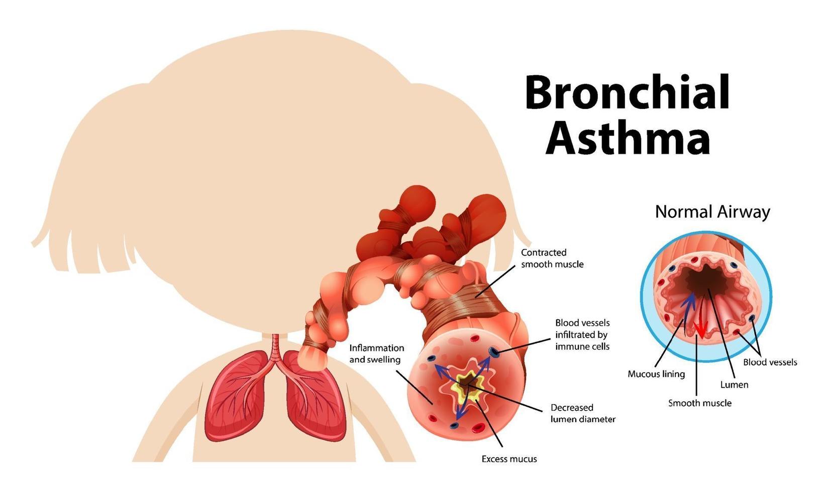 diagrama de asma brônquica com via aérea normal e via aérea asmática vetor