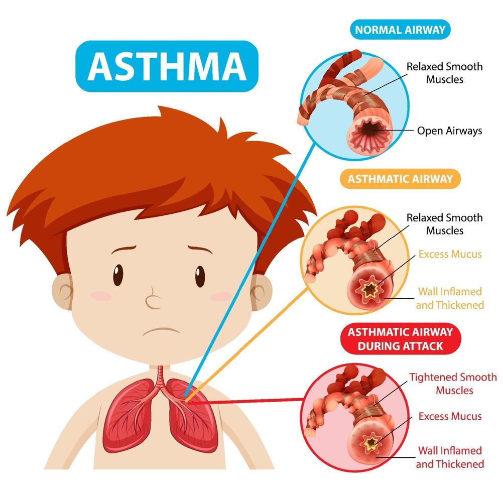 diagrama de asma com via aérea normal e via aérea asmática vetor