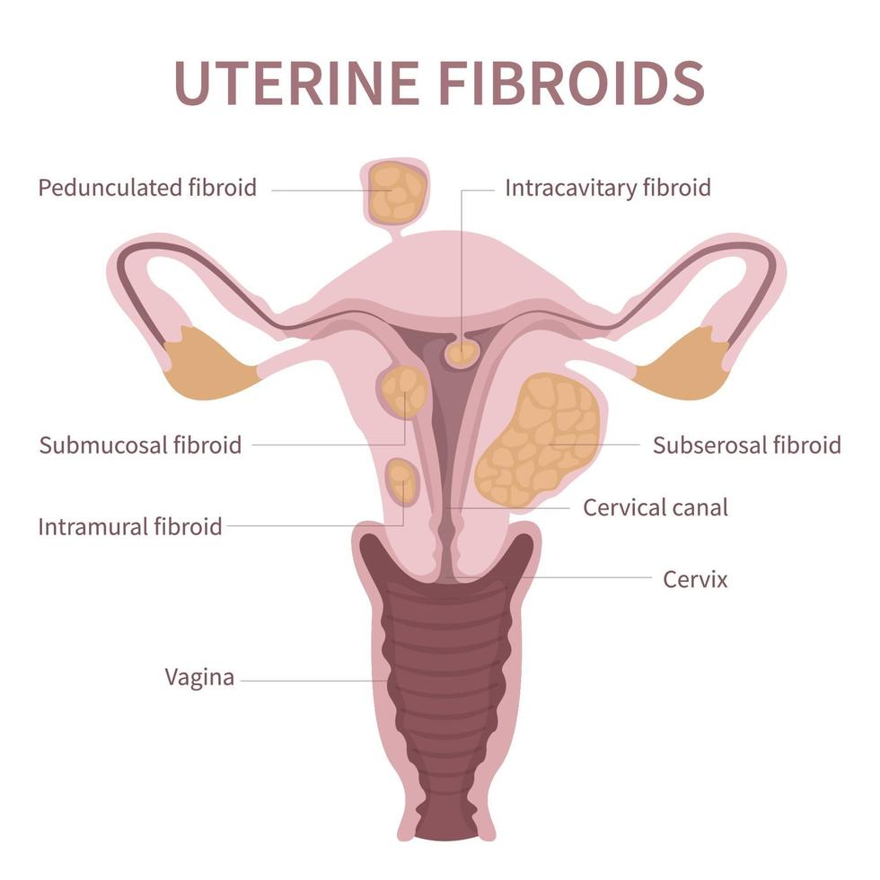 diagrama de miomas uterinos de mulher em fundo branco vetor