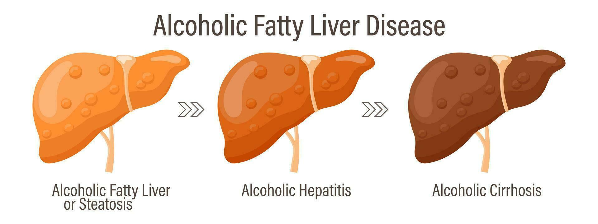 tipos do gordinho fígado. humano fígado doenças. alcoólico gordinho fígado doença. hepatite, fígado cirrose, fibrose, esteatose. médico infográfico bandeira. vetor