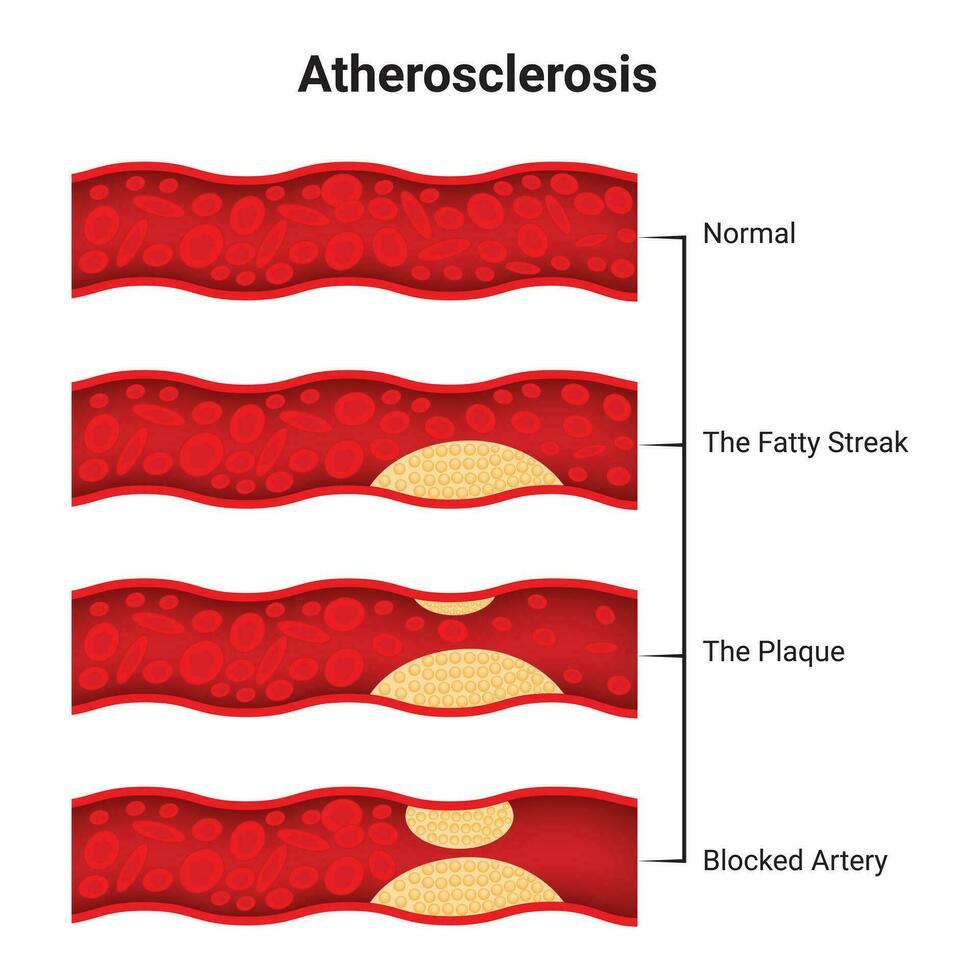 aterosclerose Ciência Projeto vetor ilustração diagrama