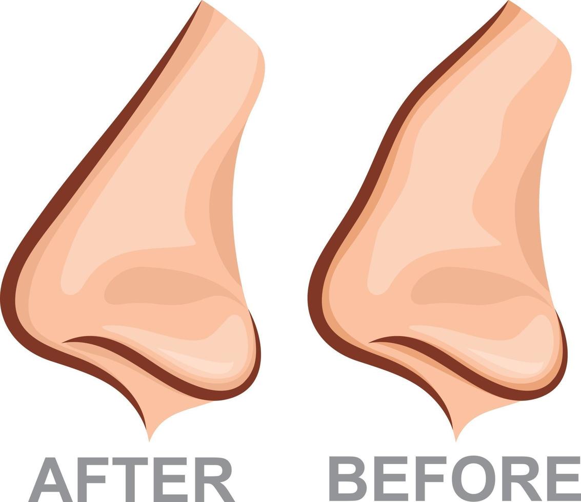 nariz antes e depois da rinoplastia vetor