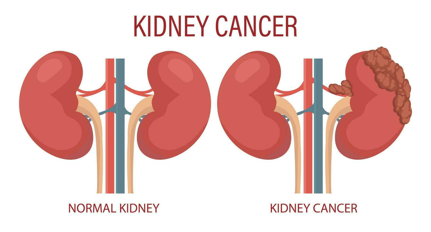 rim Câncer. humano rim doença. médico infográfico bandeira, ilustração, vetor