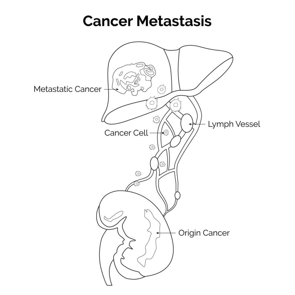 Câncer metástase Ciência Projeto vetor ilustração diagrama