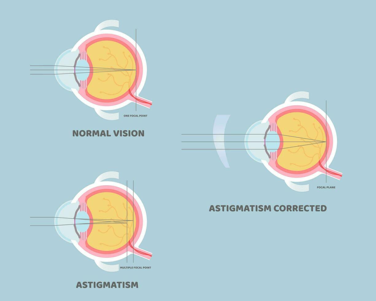 globo ocular anatomia, interno órgãos corpo parte nervoso sistema, astigmatismo corrigido, visão conceito, vetor ilustração desenho animado plano Projeto grampo arte