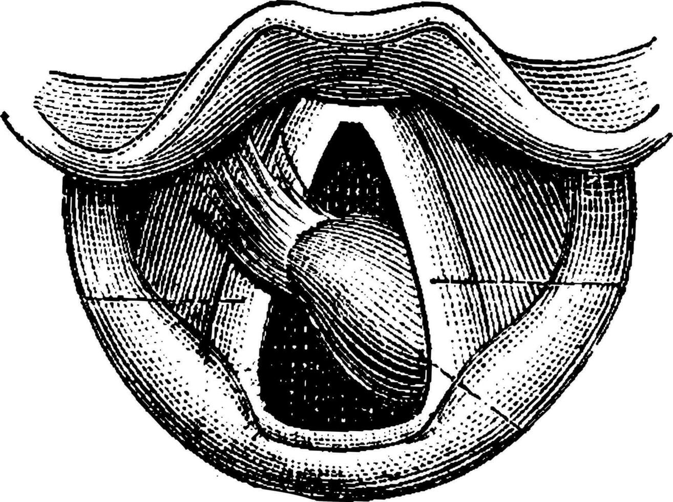 fibroma do a laringe, vintage gravação vetor
