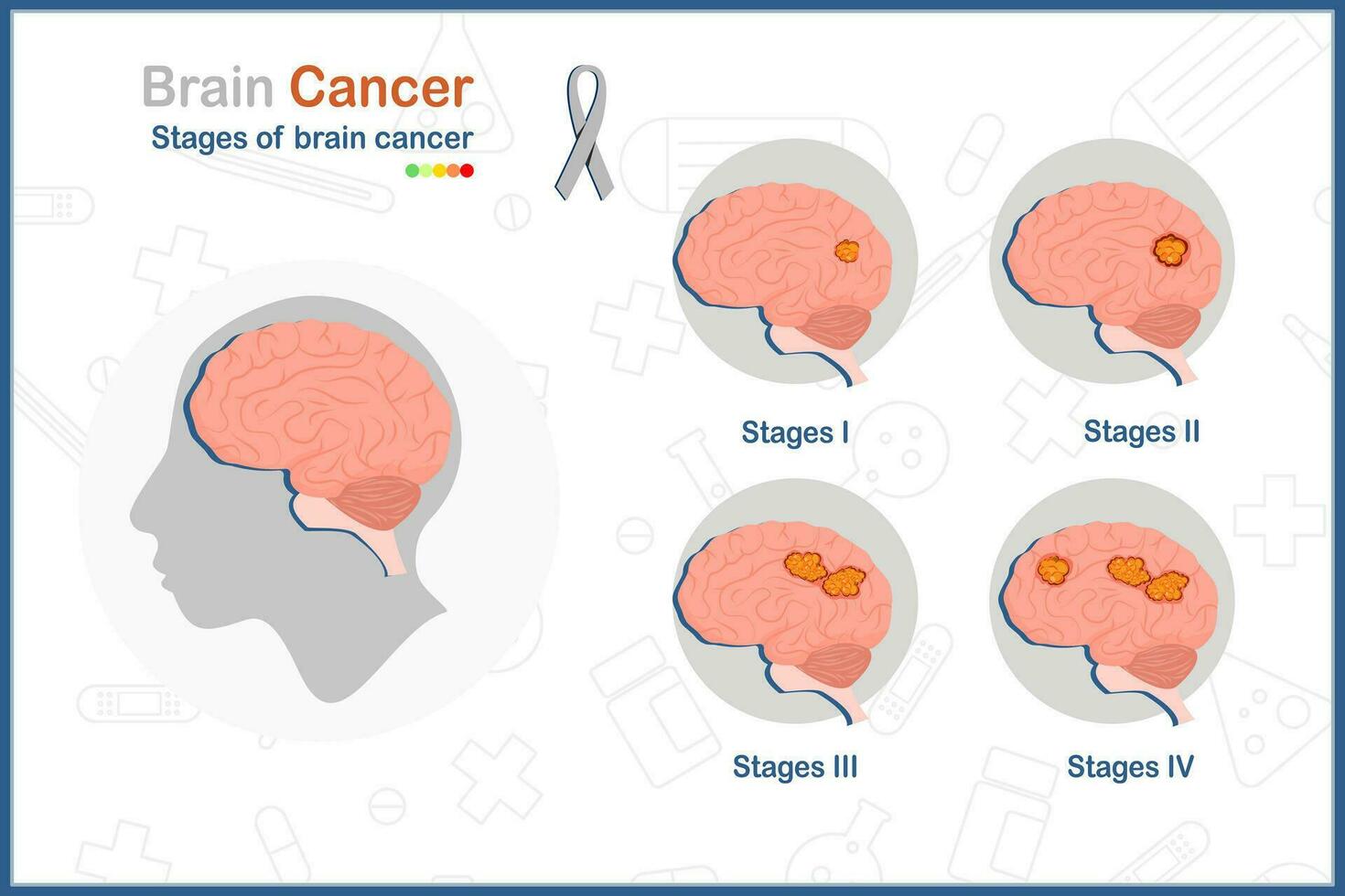 cérebro Câncer. médico vetor ilustração dentro plano estilo do a quatro estágios do cérebro câncer.isolado em branco plano de fundo.saúde Cuidado e médico conceitos.