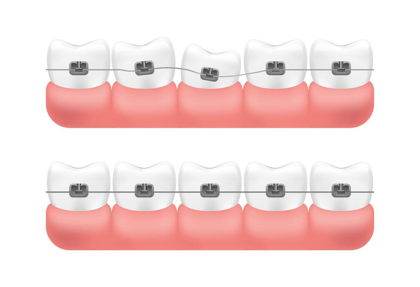 correção de mordida com auxílio de sistema de colchetes. alinhamento dos dentes. vetor. vetor