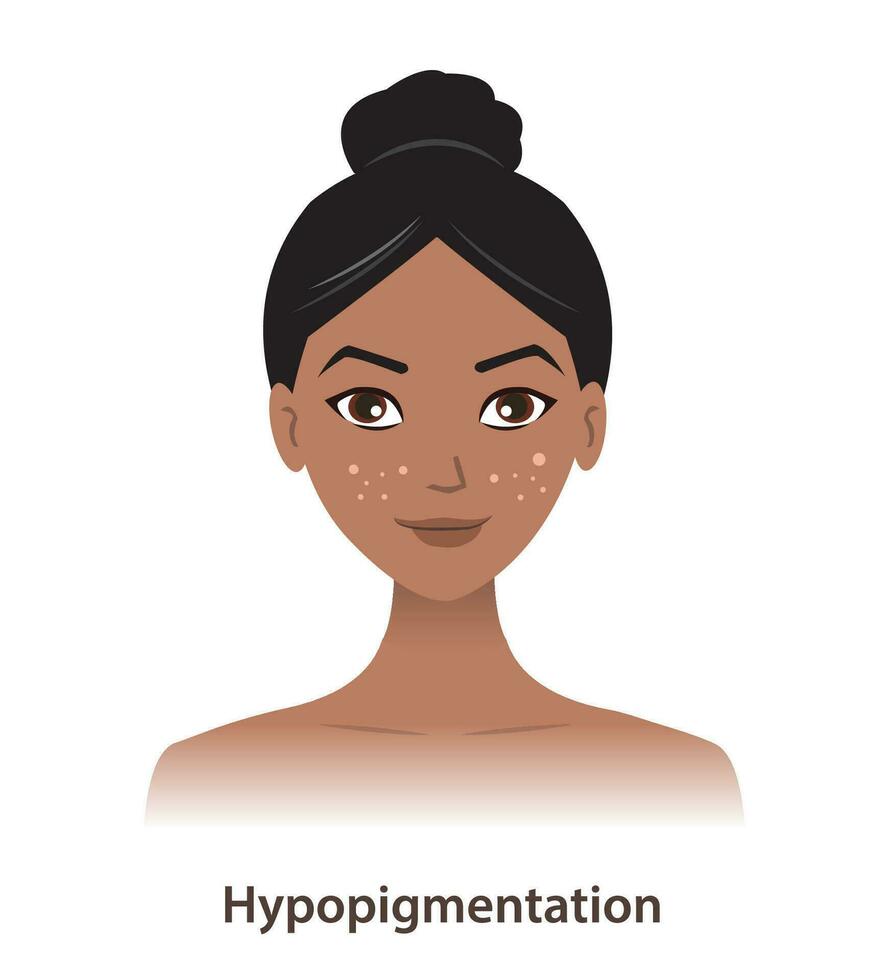 hipopigmentação e branco pontos em mulher face vetor isolado em branco fundo. pele pigmento descoloração, iluminado pigmento, uma baixo montante do melanina dentro pele. pele pigmento desordens conceito.