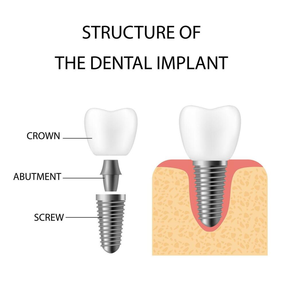 dental implantar. realista implantar estrutura, gráfico modelos do a coroa. parafuso prótese, ortodôntico dental implantação vetor