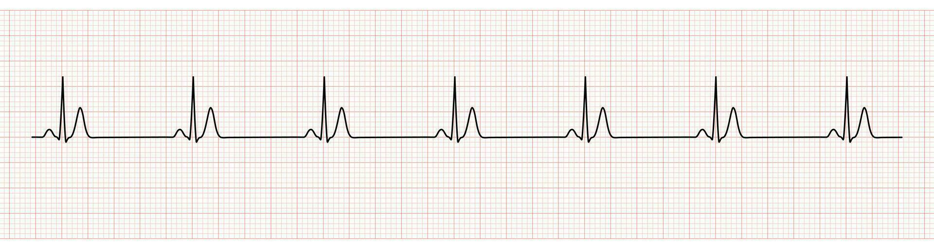 ekg monitor mostrando seio ritmo com curto qt intervalo vetor