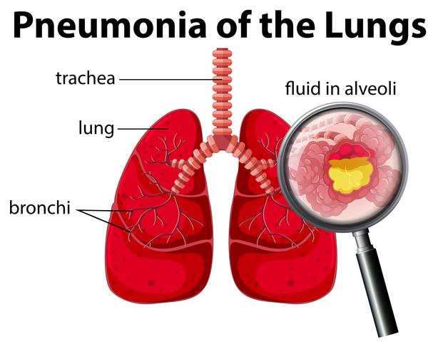 Pneumonia do Diagrama Pulmonar vetor