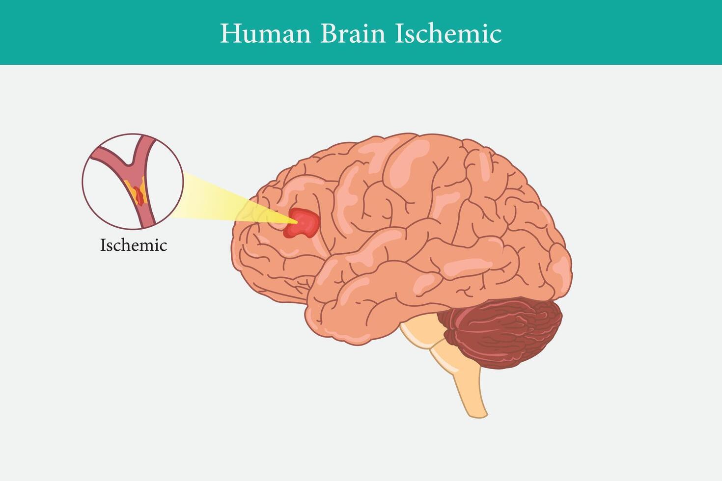 humano anatomia doença isquêmico acidente vascular encefálico vetor ilustração em branco fundo. eps 10