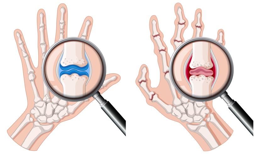 Uma mão humana com artrite reumatóide vetor