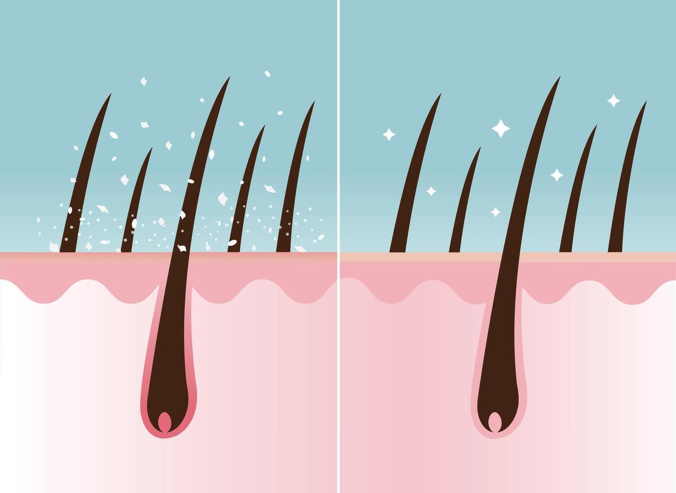 comparação do caspa dentro cabelo e saudável cabelo em couro cabeludo camada vetor ilustração. cabelo com branco seco escamoso, escamoso couro cabeludo e nutrido. cabelo Cuidado e problema conceito.