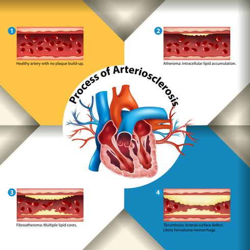 Cartaz do Processo de Arteriosclerose vetor