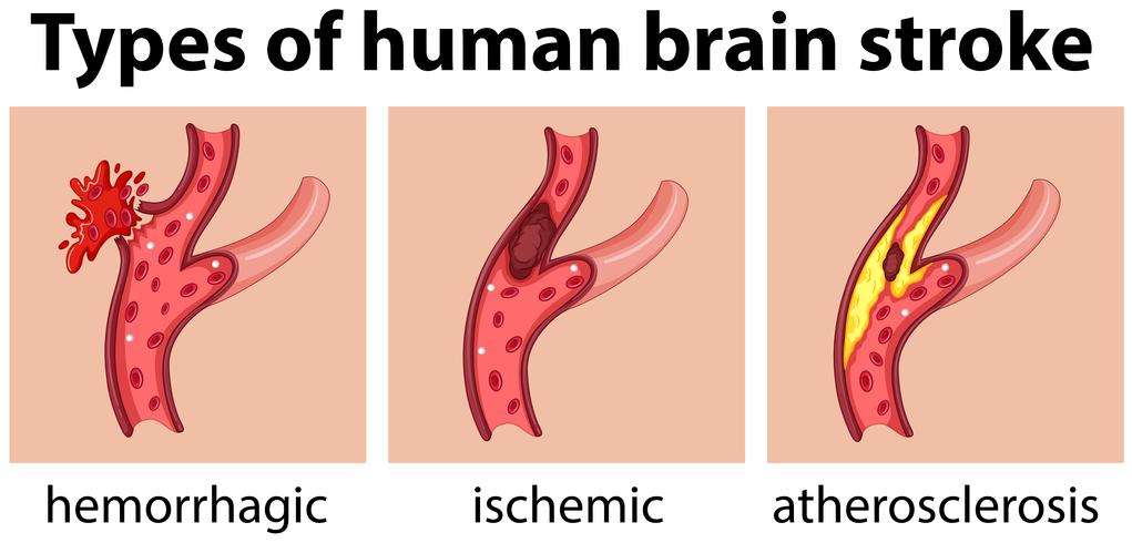 Tipos de acidente vascular cerebral humano vetor