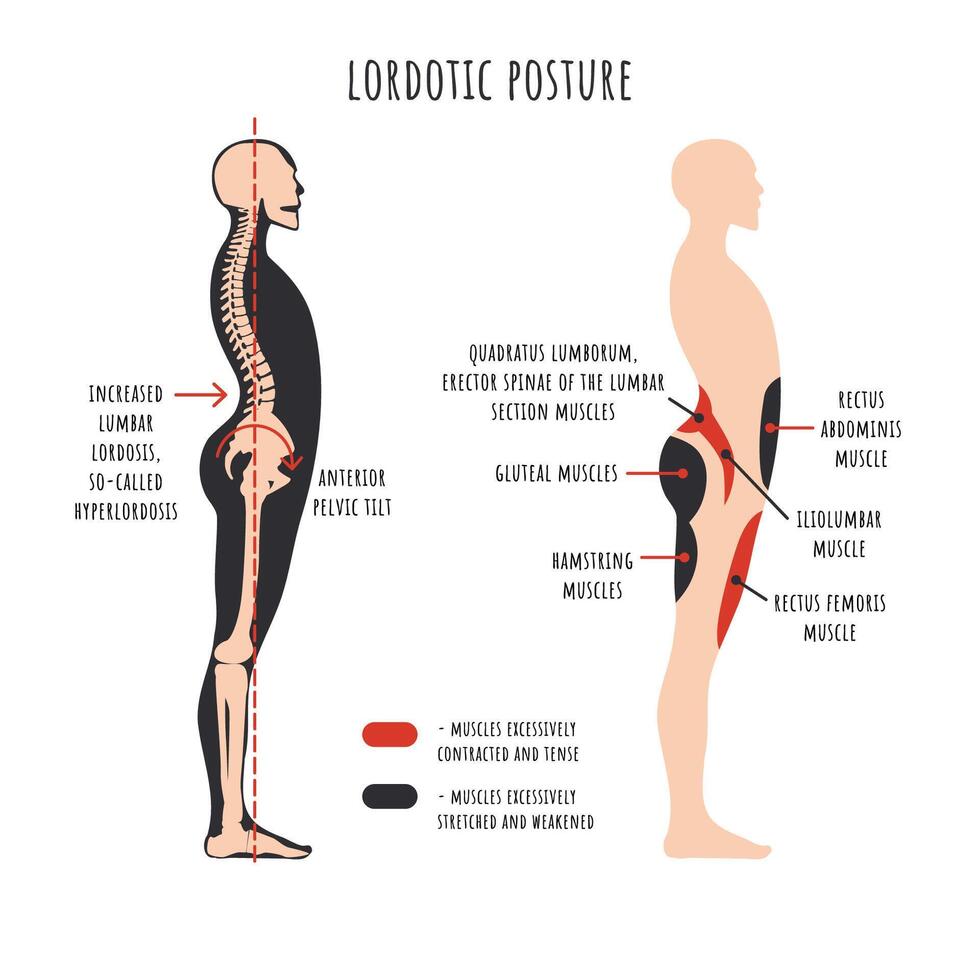 lordótico postura. lado Visão mostra hiperlordose deformação, coluna vertebral curvatura, pélvis rotação, esticado e enfraquecido, encurtado e dezenas músculos. vetor