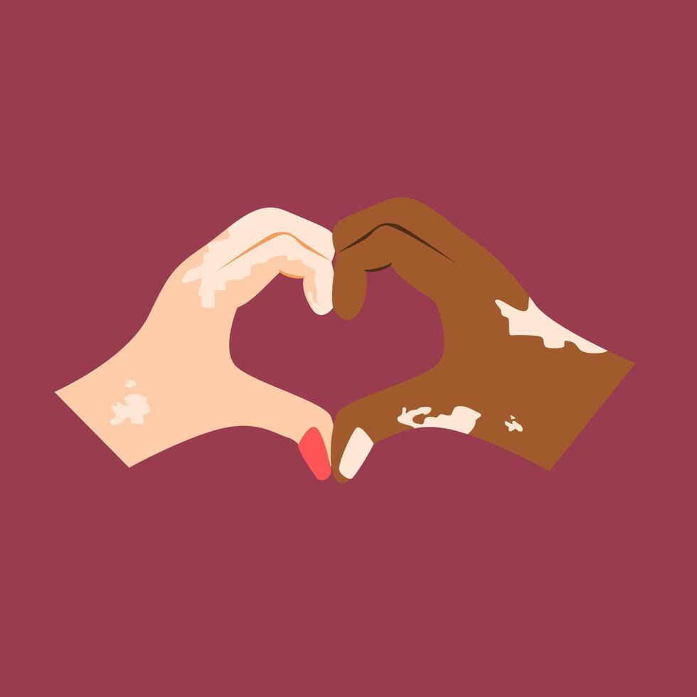 ilustração do dois mãos formando uma coração com ambos mãos sofrimento a partir de vitiligo vetor