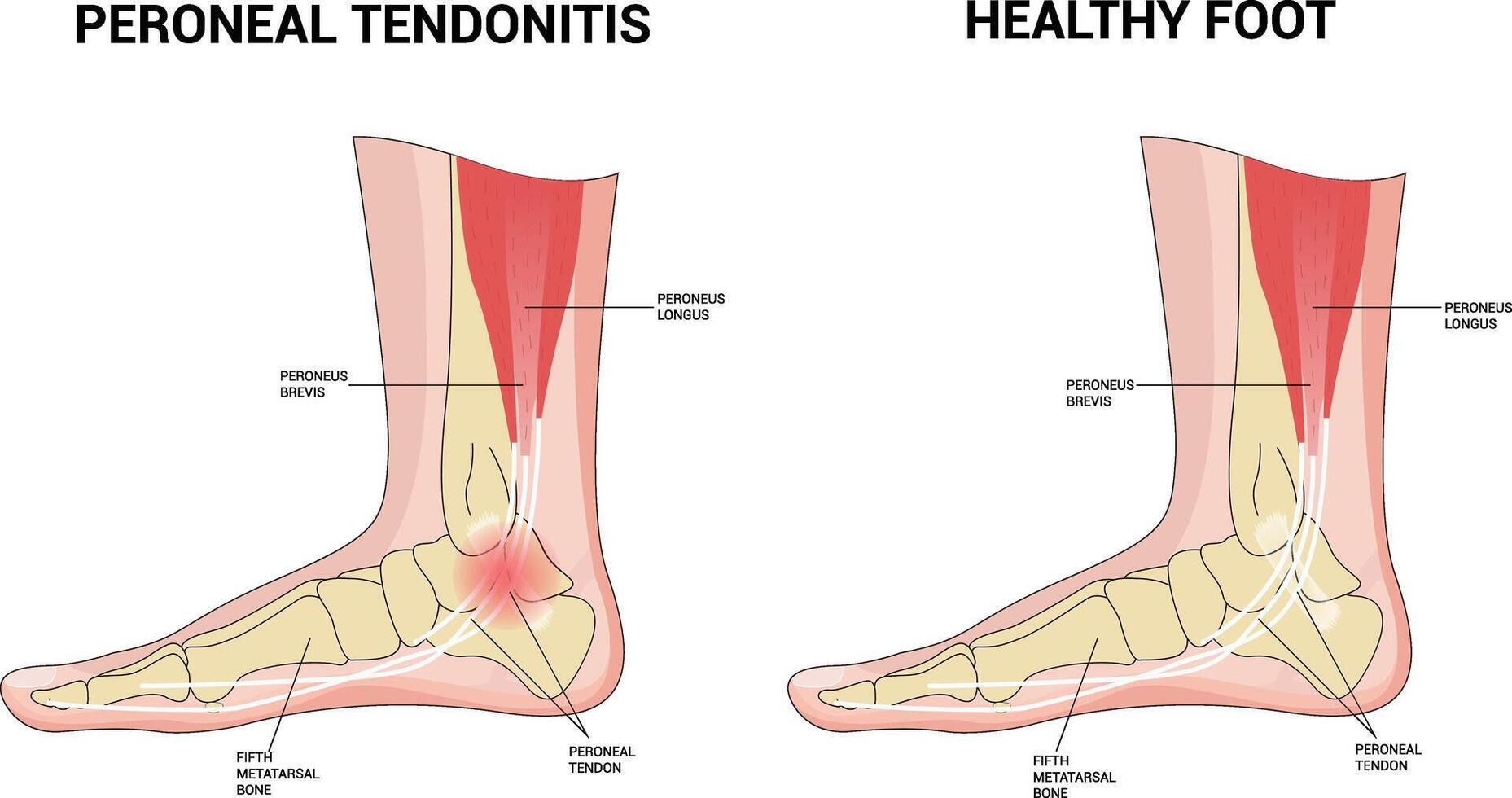 fibular tendinite Ciência ilustração vetor