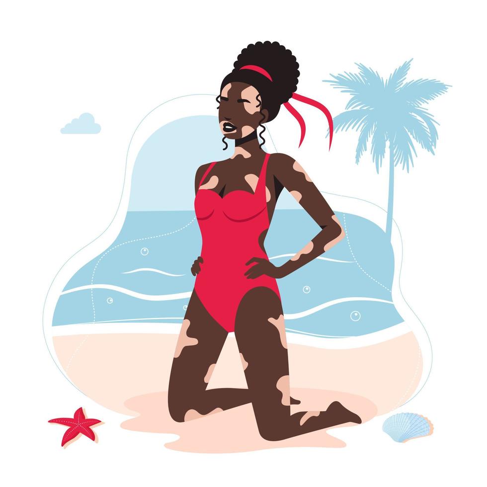 Doença de pele de vitiligo em garota afro-americana em um maiô. mulher com diagnóstico de vitiligo tomando banho de sol na praia não é tímida. o conceito de beleza diferente, auto-aceitação corporal positiva. vetor
