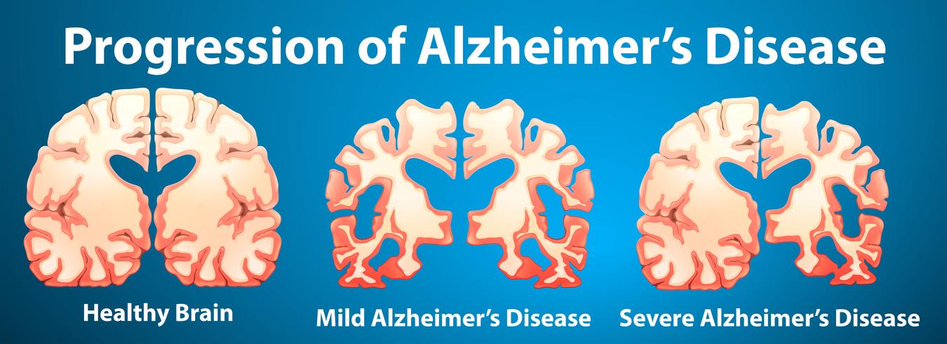 Progressão da doença de Alzheimer em fundo azul vetor