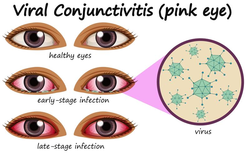 Doença do olho humano com conjuntivite viral vetor