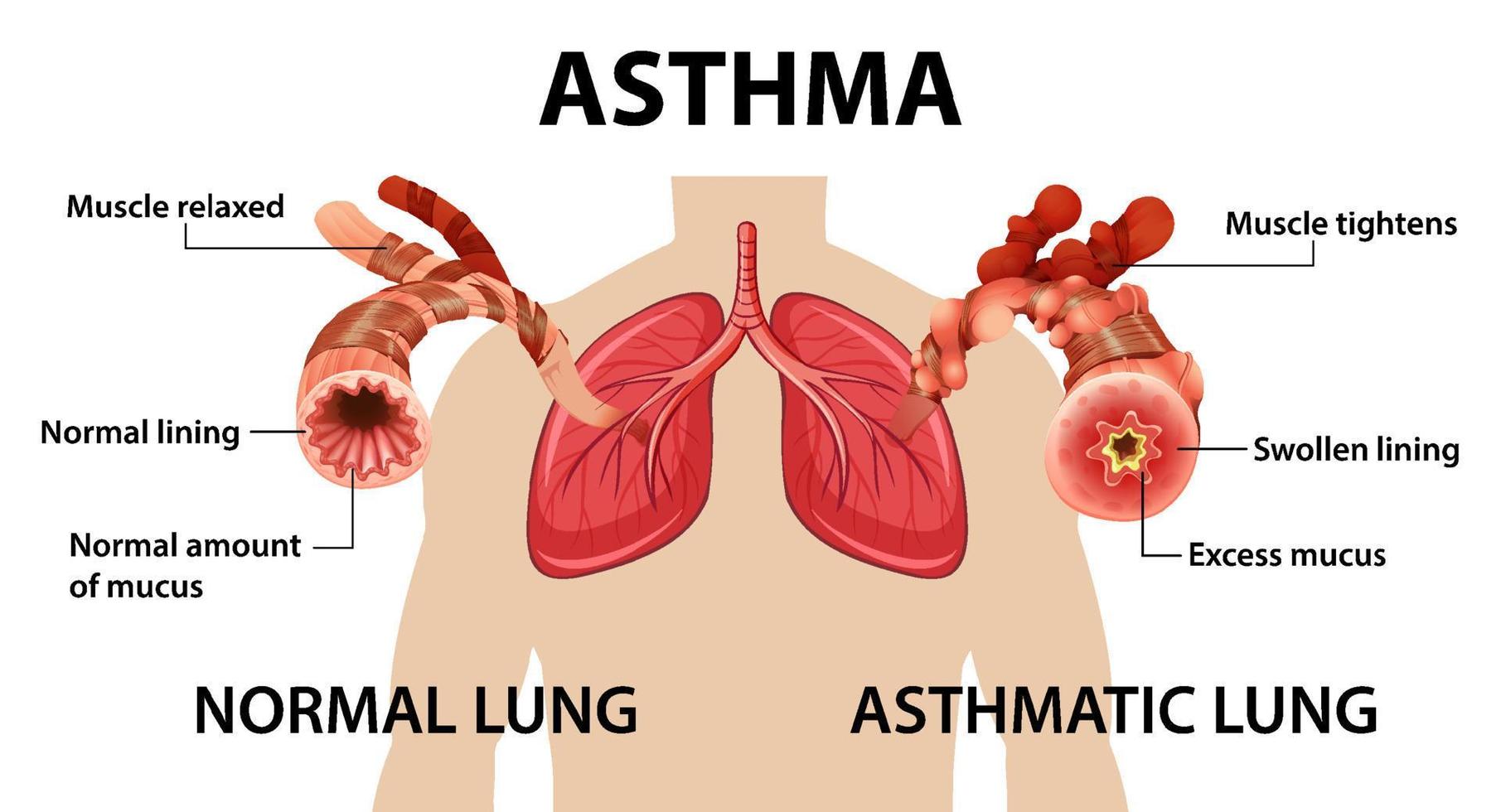 diagrama de asma brônquica com pulmão normal e pulmão asmático vetor