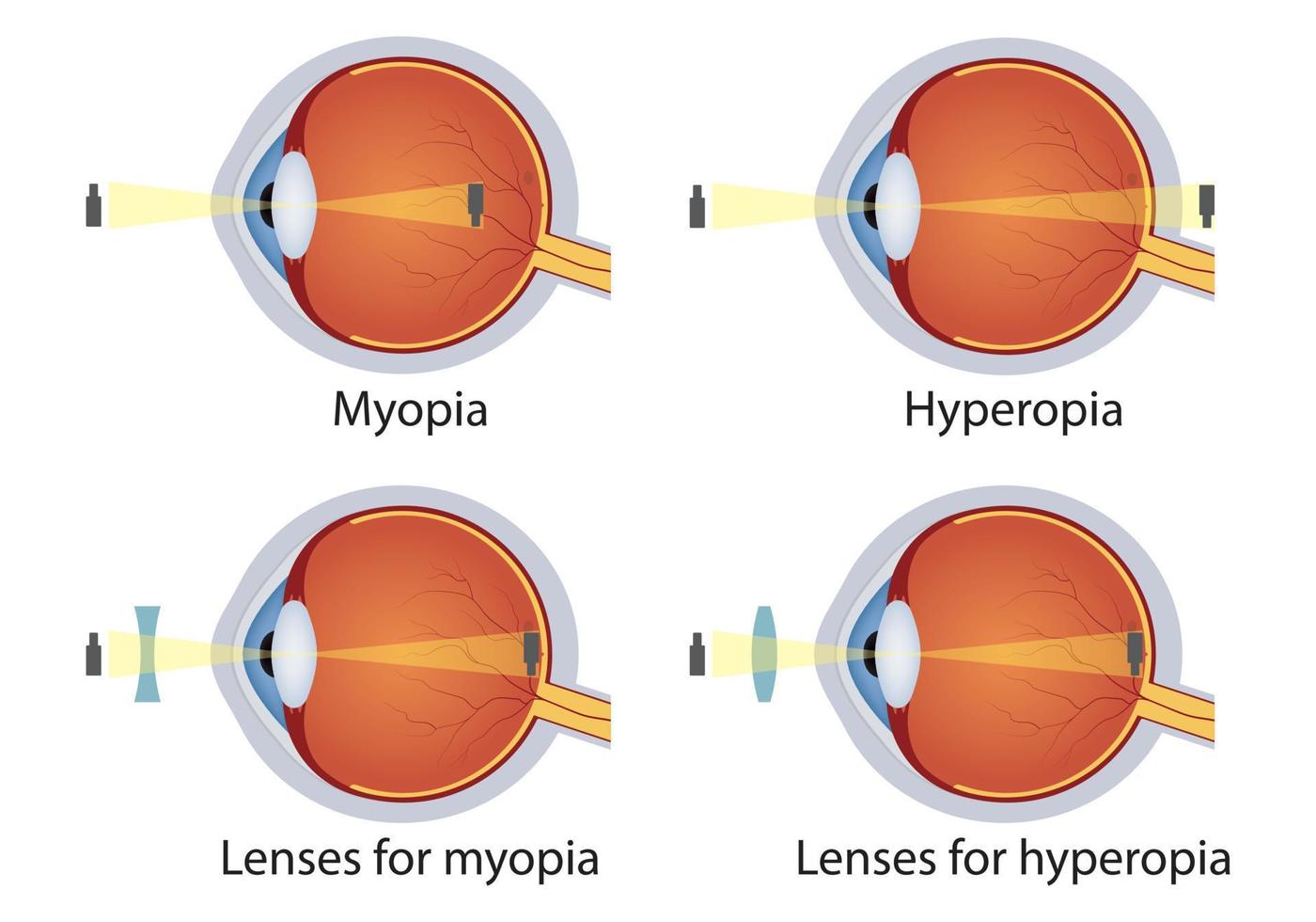 hipermetropia e miopia corrigidas por lentes. conceito de defeito nos olhos. correção de vários distúrbios da visão ocular por lentes. vetor