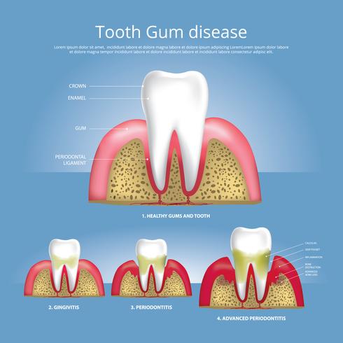Estágios de dentes humanos de ilustração em vetor de doença de goma