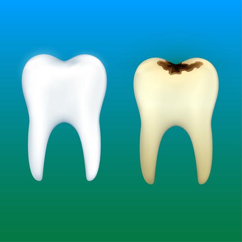 Dentes branqueamento e cárie dentária, vetor de saúde dental.