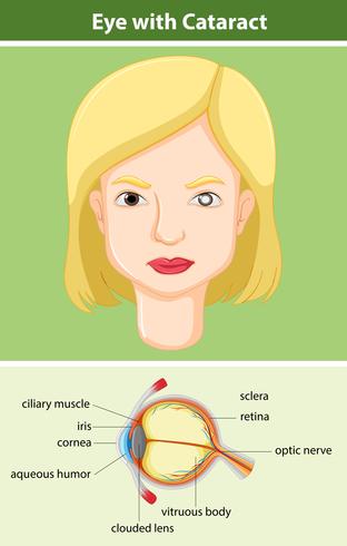Diagrama mostrando o olho com catarata vetor