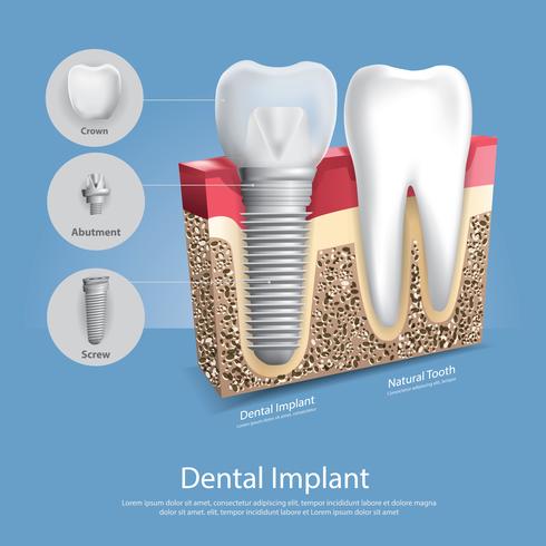 Dentes humanos e ilustração vetorial de implante dentário vetor
