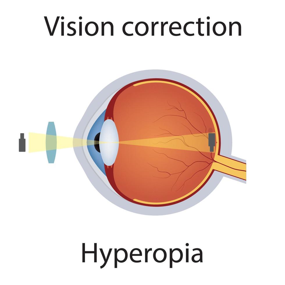 correção de visão de ilustração de hipermetropia. distúrbios da visão. defeito de olhos corrigido pelo conceito de lente convexa. globo ocular de anatomia detalhada com defeito de hipermetropia. vetor isolado