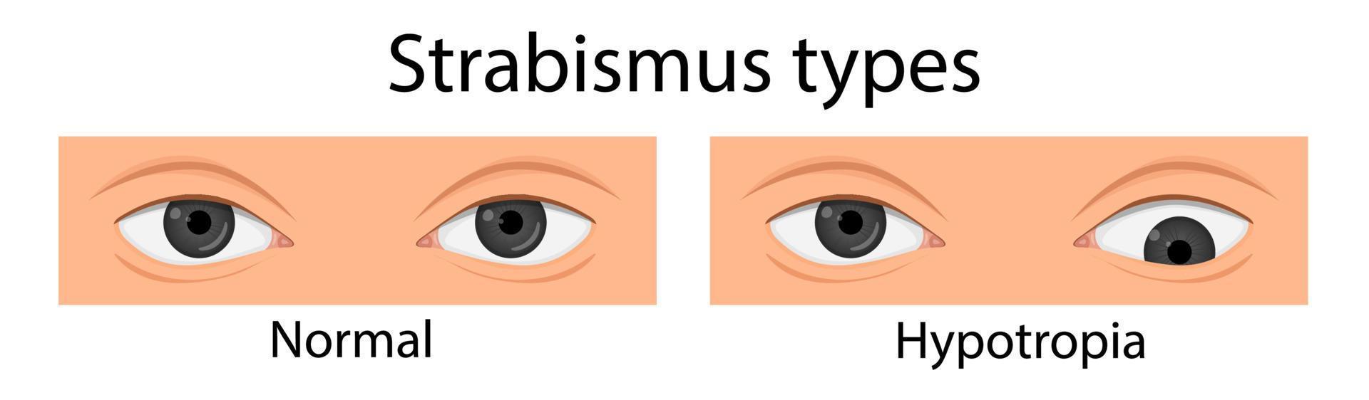 tipos de estrabismo. hipotropia, hipertropia, esotropia. estilo de desenho animado vetor