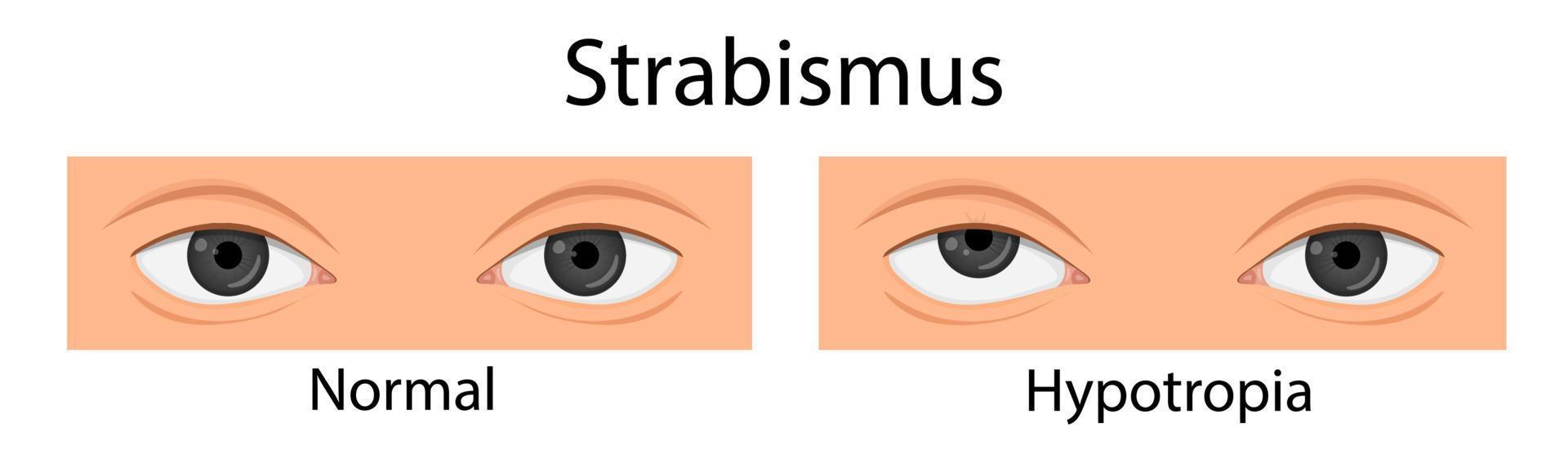 tipos de estrabismo. hipotropia, hipertropia, esotropia. estilo de desenho animado vetor