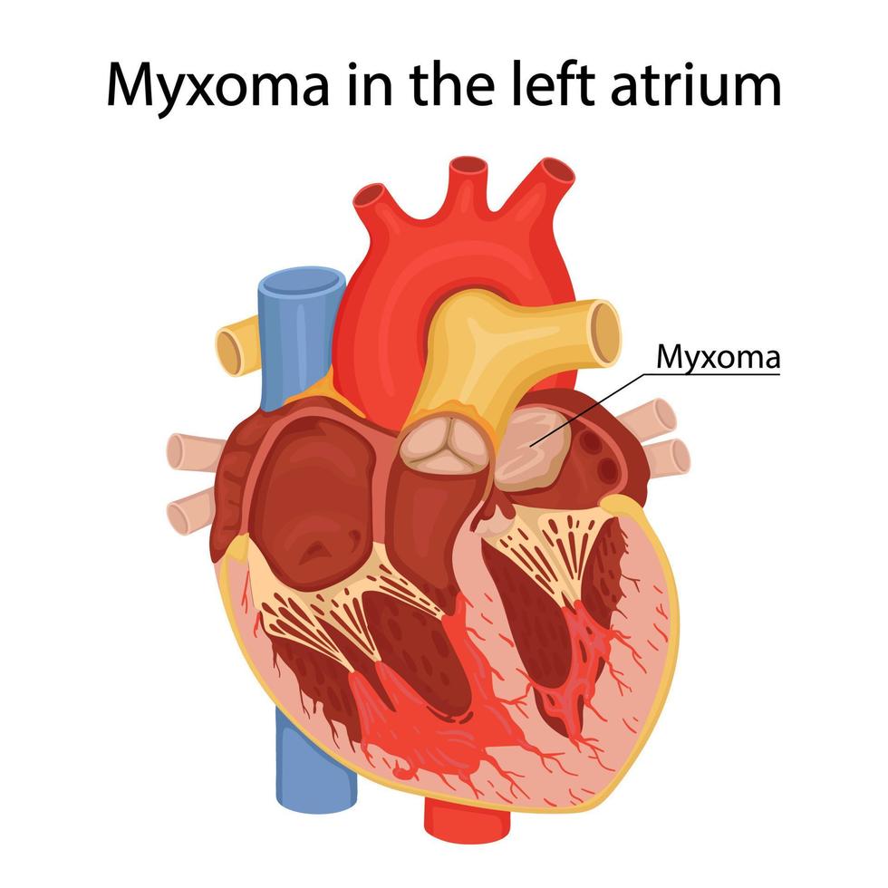 mixoma atrial. câncer, tumor benigno. ilustração vetorial em estilo cartoon vetor