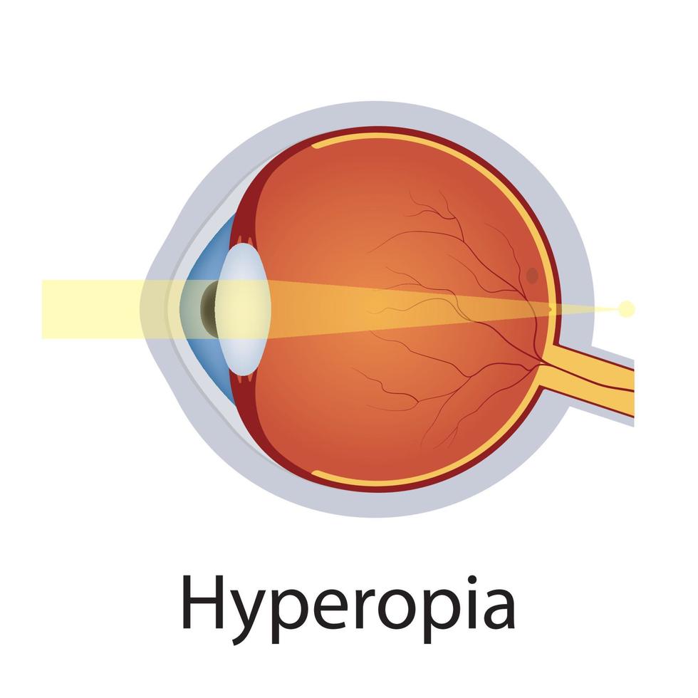 ilustração de distúrbios de visão e hipermetropia. conceito de defeito de olhos. globo ocular de anatomia detalhada com defeito de hipermetropia. vetor isolado