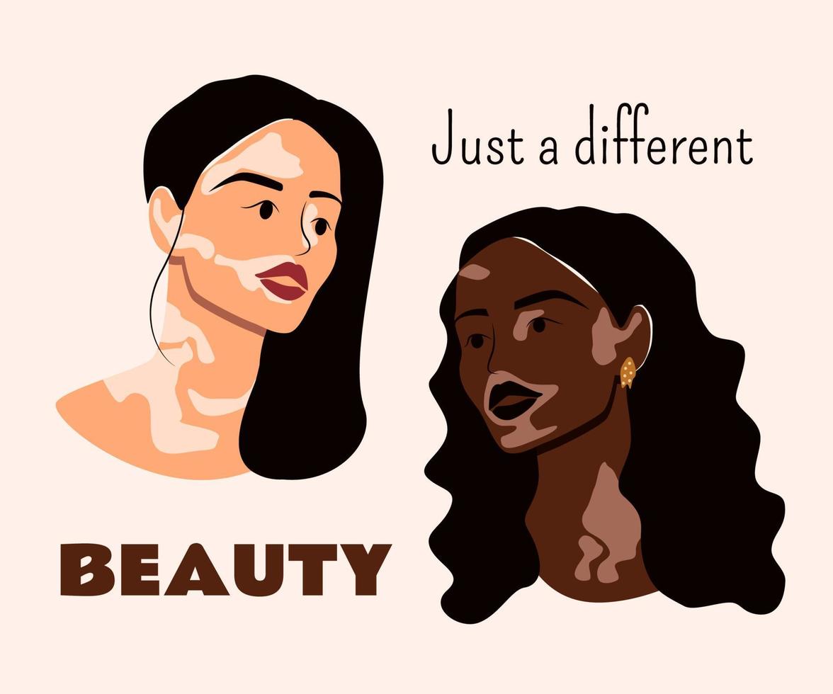 mulheres jovens vivem com vitiligo. beleza diferente, amor próprio e conceito de doença de pele vitiligo. ilustração vetorial plana isolada em fundo bege vetor